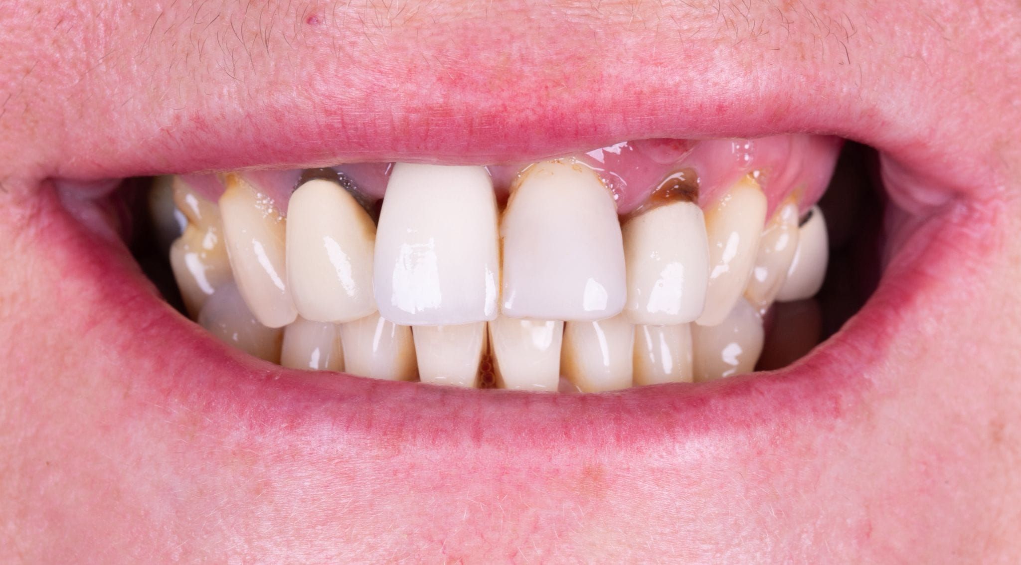 Caso 2 antes del tratamiento: dientes desgastados y con diferencias de color