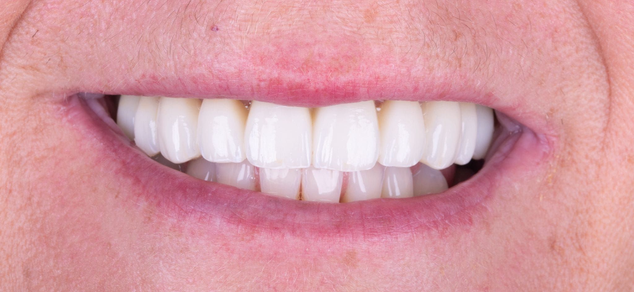Caso 2 después del tratamiento: dientes uniformes con prótesis fijas
